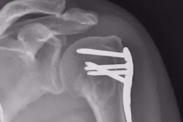 Shoulder Trauma