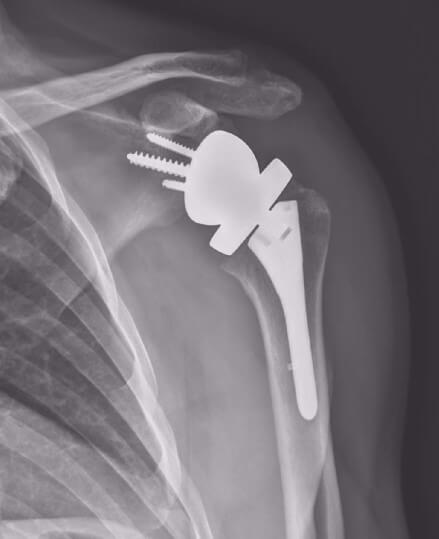x ray rotator cuff surgery.
