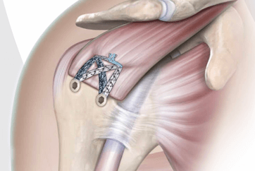 Rotator Cuff Tears