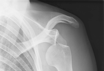 Shoulder Instability