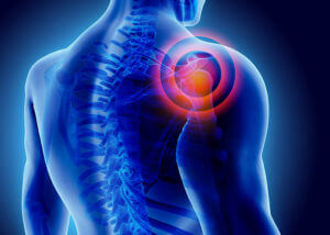3D Illustration of shoulder arthritis, medical concept.