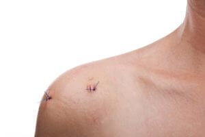 shoulder with healing stitches