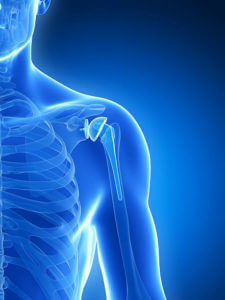 3d rendered illustration of a shoulder replacement