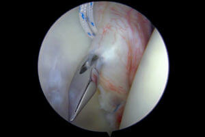 Arthroscopic (keyhole) view (from the posterior portal) of a right shoulder during repair of a Bankart lesion (avulsion of the anterior-inferior part of the labrum from the glenoid - resulting in instability and dislocations) with suture anchors. The first anchor has been placed and the have been securely tied. The surgeon has just placed the second suture anchor and is a using a “sewing machine” (bird beak tool or surgical instrument) to retrieve one of the suture ends through the base of the labrum close to glenoid to tie the next suture. The humeral head is on the right side of the image. The glenoid is to the left. The image is part of a series.