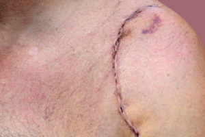 Shoulder surgery