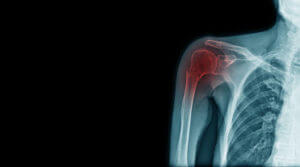 x-ray fracture of acromion process and neck of humerus bone