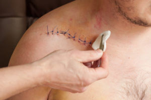 A patient with stitches on his shoulder after rotator cuff repair surgery requires proper postoperative care.